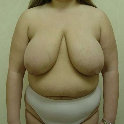 Mommy Makeover Before & After Patient #971