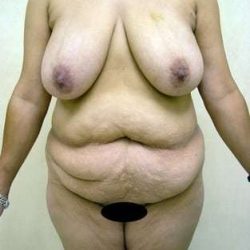 Mommy Makeover Before & After Patient #977