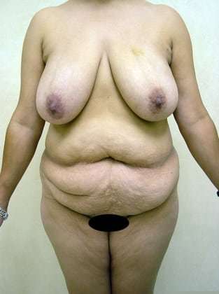Mommy Makeover Before & After Patient #977