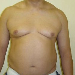 Male Chest Implant Before & After Patient #980