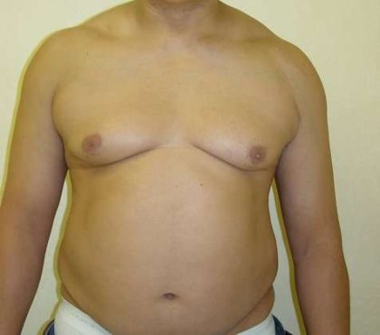 Male Chest Implant Before & After Patient #980