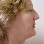 Rhinoplasty Before & After Patient #200