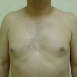 Liposuction Before & After Patient #997