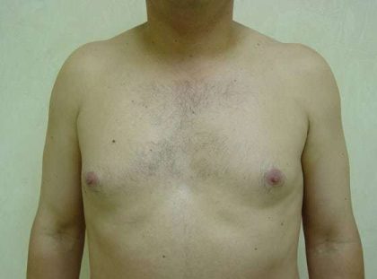 Liposuction Before & After Patient #997