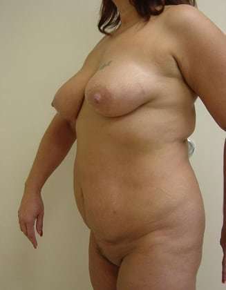Liposuction Before & After Patient #1000