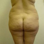 Liposuction Before & After Patient #1007