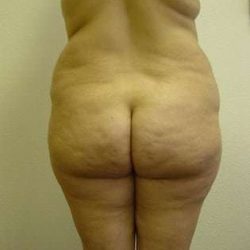 Liposuction Before & After Patient #1007