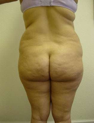 Liposuction Before & After Patient #1007