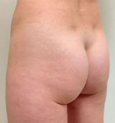 Brazilian Butt Lift Before & After Patient #1013