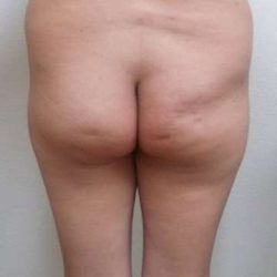 Brazilian Butt Lift Before & After Patient #1024