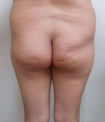 Brazilian Butt Lift Before & After Patient #1024