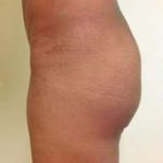 Brazilian Butt Lift Before & After Patient #1027