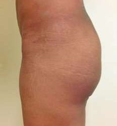 Brazilian Butt Lift Before & After Patient #1027