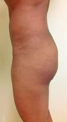 Brazilian Butt Lift Before & After Patient #1027
