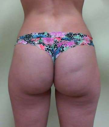 Brazilian Butt Lift Before & After Patient #1033