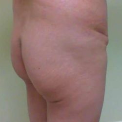Brazilian Butt Lift Before & After Patient #1036