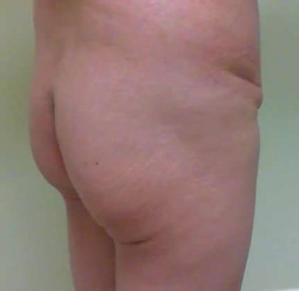 Brazilian Butt Lift Before & After Patient #1036
