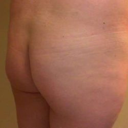 Brazilian Butt Lift Before & After Patient #1039