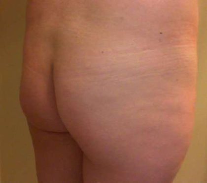 Brazilian Butt Lift Before & After Patient #1039