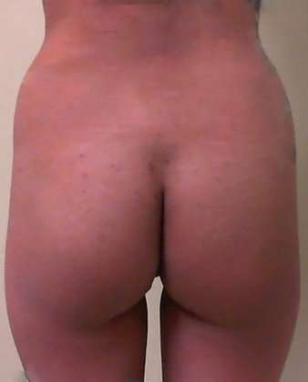 Brazilian Butt Lift Before & After Patient #1049