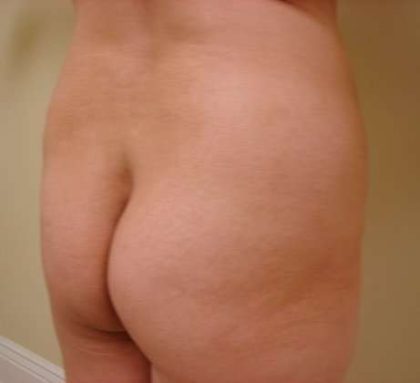 Brazilian Butt Lift Before & After Patient #1052