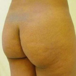 Brazilian Butt Lift Before & After Patient #1055