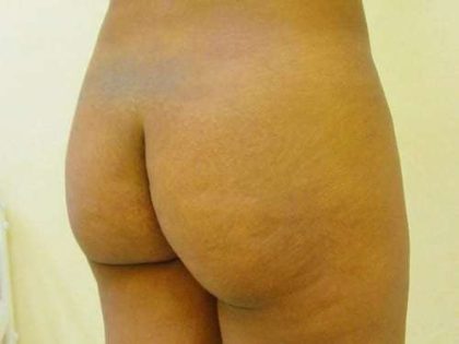 Brazilian Butt Lift Before & After Patient #1055