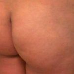 Brazilian Butt Lift Before & After Patient #1059