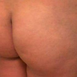 Brazilian Butt Lift Before & After Patient #1059