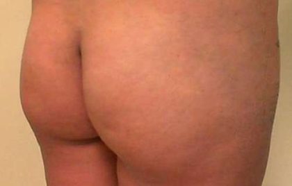 Brazilian Butt Lift Before & After Patient #1059