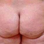 Brazilian Butt Lift Before & After Patient #1062