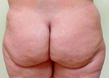 Brazilian Butt Lift Before & After Patient #1062