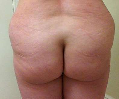 Brazilian Butt Lift Before & After Patient #1065