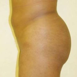 Brazilian Butt Lift Before & After Patient #1072