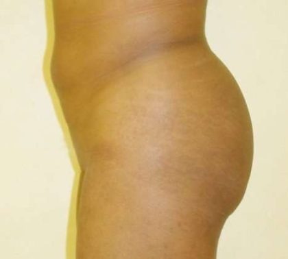 Brazilian Butt Lift Before & After Patient #1072