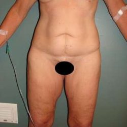 Body Contouring Before & After Patient #1076