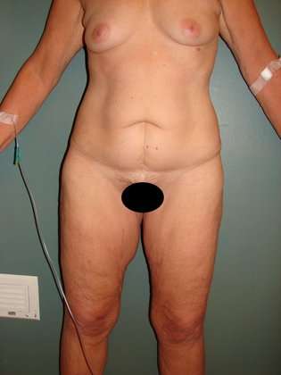 Body Contouring Before & After Patient #1076