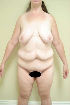 Body Contouring Before & After Patient #1079