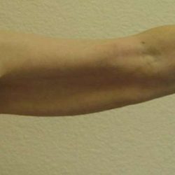 Arm Lift Before & After Patient #1082