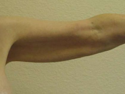 Arm Lift Before & After Patient #1082