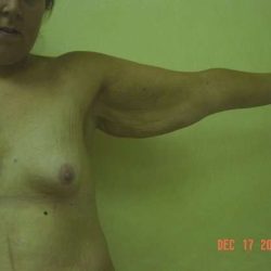 Arm Lift Before & After Patient #1086