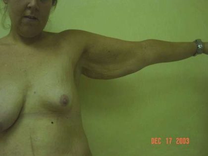 Arm Lift Before & After Patient #1086