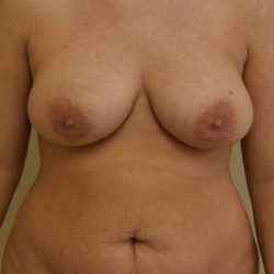 Abdominoplasty Before & After Patient #1093