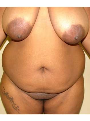 Abdominoplasty Before & After Patient #1098