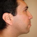 Rhinoplasty Before & After Patient #209