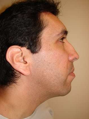 Rhinoplasty Before & After Patient #209