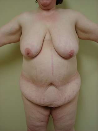 Abdominoplasty Before & After Patient #1110