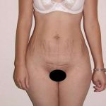 Abdominoplasty Before & After Patient #1130
