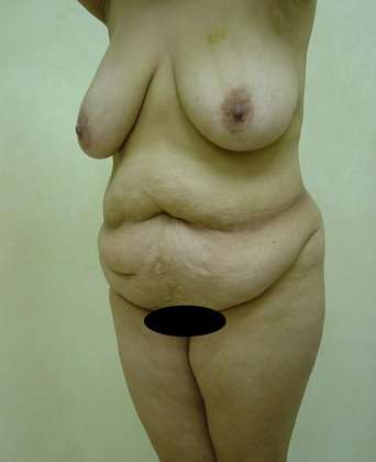 Abdominoplasty Before & After Patient #1137
