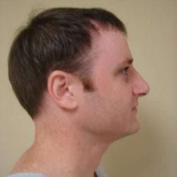 Rhinoplasty Before & After Patient #213